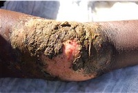 Burn wound treated with cow manure.